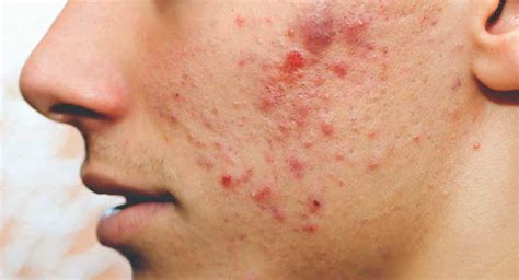 Acne Pimple Treatment Best Dermatologist In Pune Skin Specialist