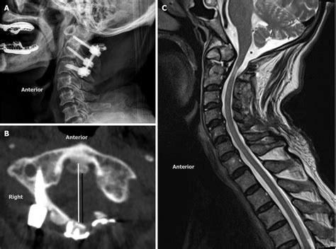 Postoperative Images During The 3 Yr Follow Up A Lateral Radiograph