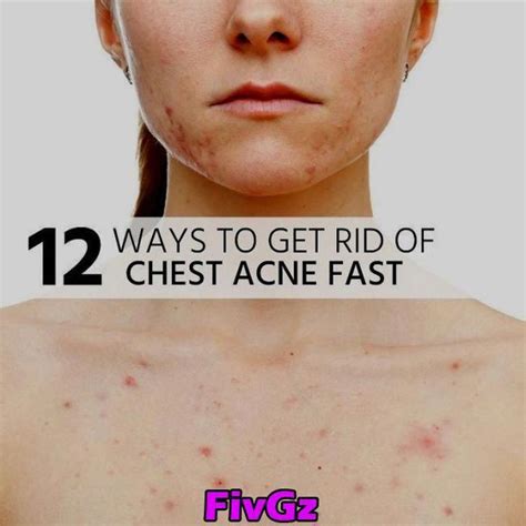 How To Get Rid Of Acne On Chest Howtoremvo