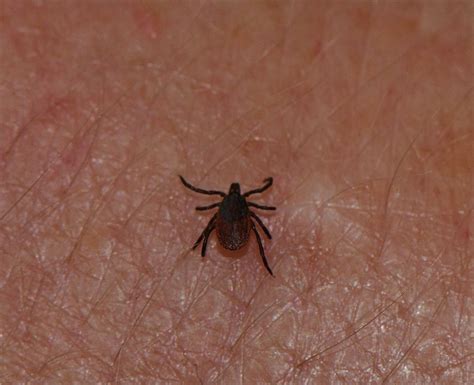 Lyme Disease Becoming More Common In Britain