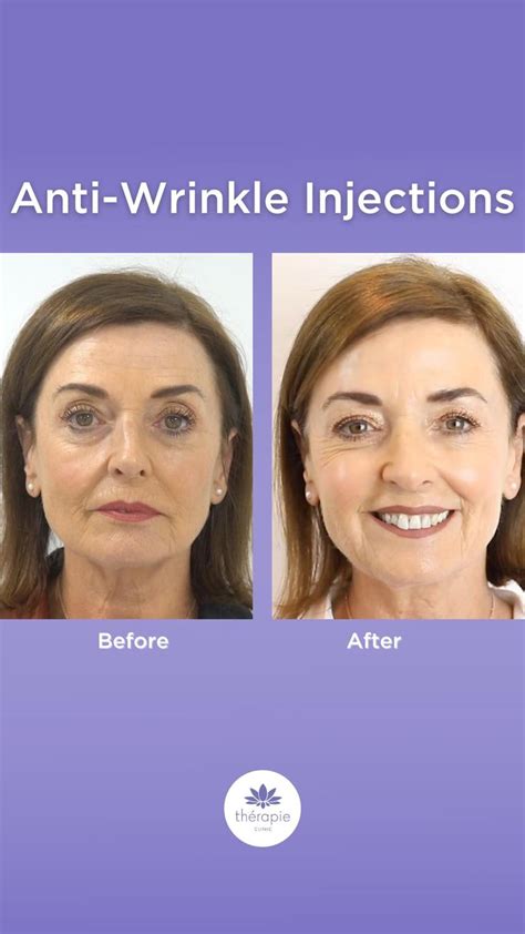 Anti Wrinkle Injection Before And After Video In 2021 Anti Wrinkle
