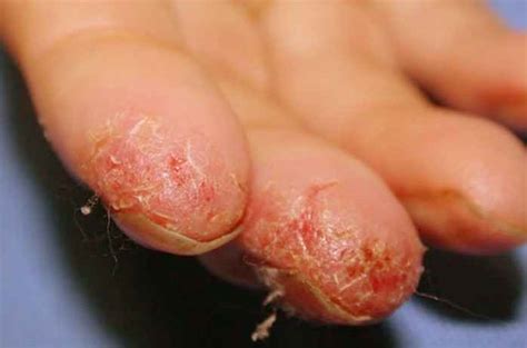 Peeling Fingertips Pictures Causes And Treatment