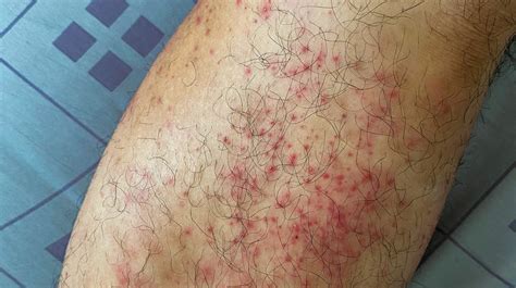 Skin Rash Itch Urticaria Allergy Clip Art Png 900x720px Clip Art