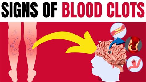 Top 10 Warning Blood Clot Symptoms You Should Never Ignore Youtube