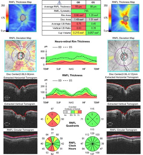 Optical Coherence Tomography OCT Applecross Eye Clinic