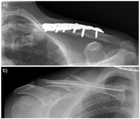 A Example Of Plate Fixation Of A Clavicle Fracture Patient Treated In