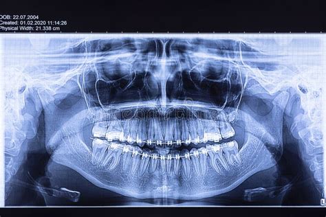 Dental Radiography With Braces Stock Photo Image Of Oral Dental