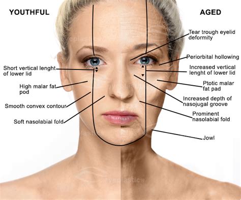 Cosmetic Eyelid Surgery Oculofacial Oculo Facial Surgeon Locatetest