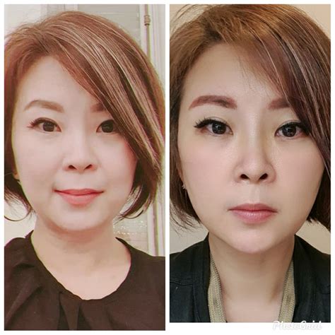 My Hiko Nose Thread Lift Review Before After Photos Included
