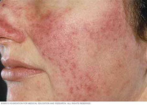 Rosacea Disease Reference Guide