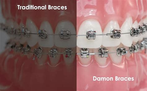 Comparison Between Traditional Braces And Damon Braces Jennings