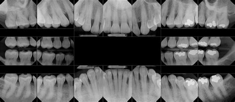 Digital X Rays — Blackhart Albertoni And Corso Dentistry