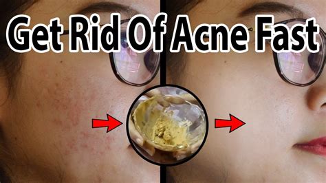 Best Home Remedies To Get Rid Of Acne From Face Acne Treatment Youtube