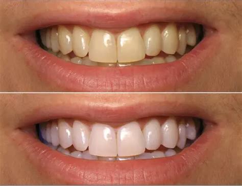 Love White Colored A Teeth Whitening Review Ncb Nebosh Igc Approved