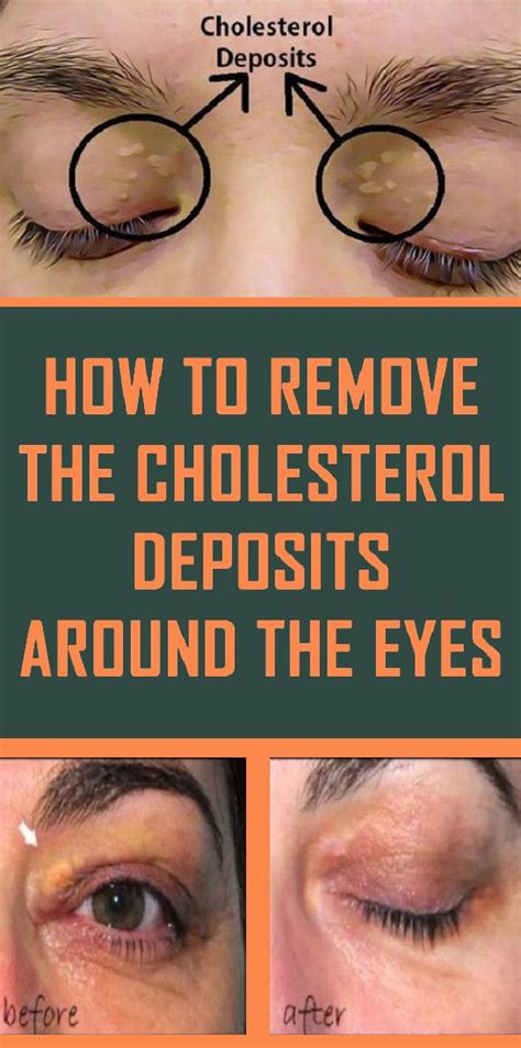 How To Remove The Cholesterol Deposits Around Your Eyes Healthy Optimum