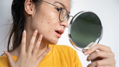 What It Really Means When Your Pimples Itch