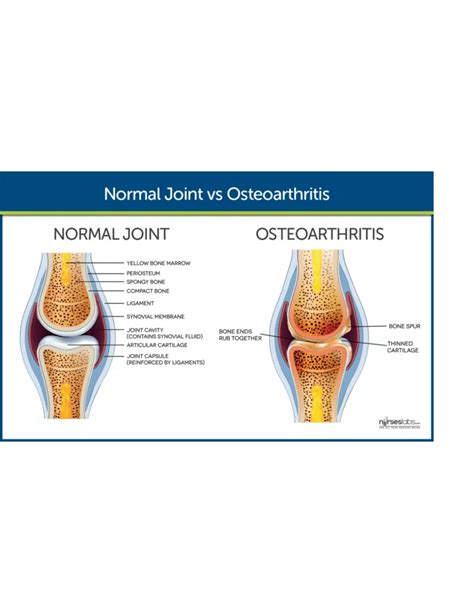 Solution Surgical Management Of Osteoarthritis Nursing Studypool