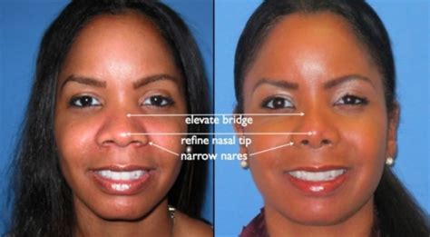 Ethnic Nose Job Before And After Photos