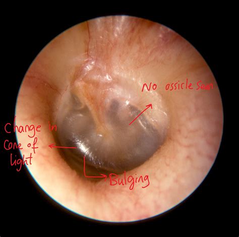 Mastoiditis other diagnostic studies - wikidoc