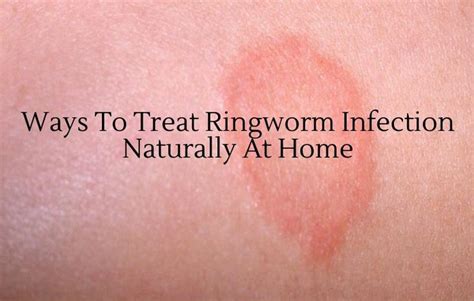 What Type Of Infection Is Ringworm