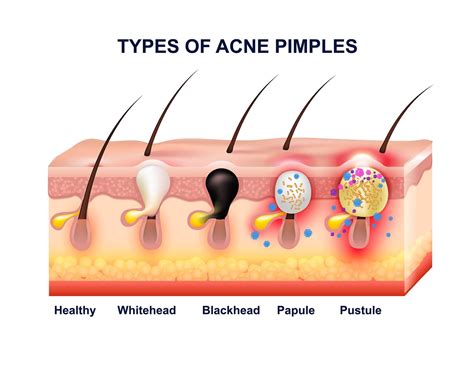 The Different Types Of Acne What Type Of Bumps And Blemishes Are