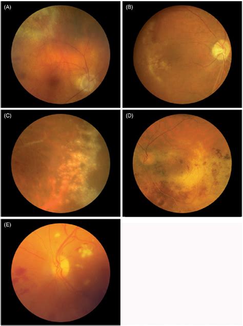 Color Fundus Photographs Of The 5 Previously Unreported Cases Of Viral