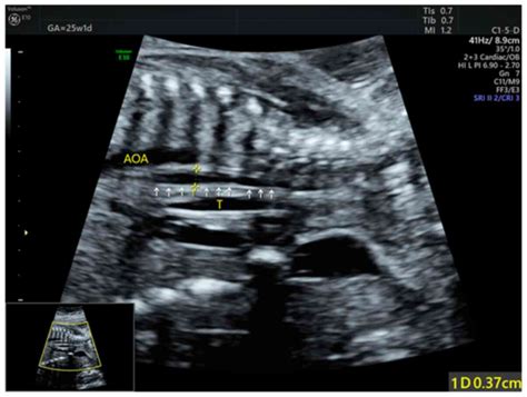 Diagnostic Accuracy Of Ultrasonography For The Prenatal Diagnosis Of