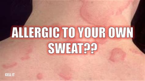 Are You Allergic To Your Own Sweat Heres Why Youtube
