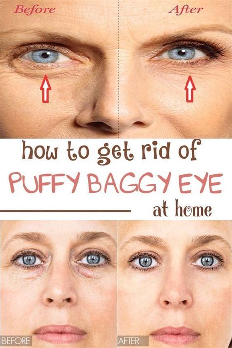 Diy How To Get Rid Of Puffy Baggy Eye At Home Baggy Eyes Puffy Eyes Remedy Puffy Eyes