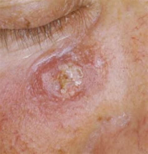 Skin Cancer Clinics In Australia Sundoctors