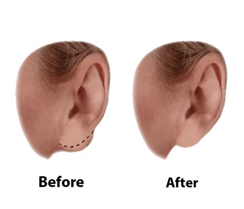Sale How To Treat A Swollen Ear Lobe In Stock