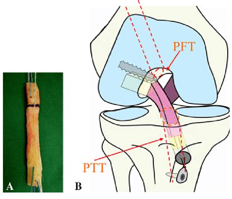 A B A A Prepared Bone Patellar Tendon Bone Btb Graft Of 10 Mm Download Scientific Diagram