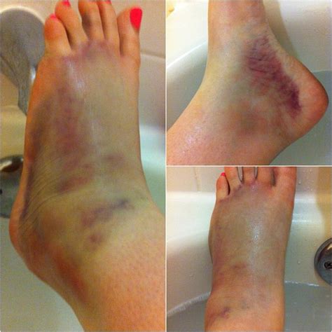 Nov 20, 2018 · a person can sprain their toe from either a specific injury or from stress due to repetitive activities, such as those of an athlete or a professional dancer. The Bargain Blonde: Snaps from Savannah, Georgia