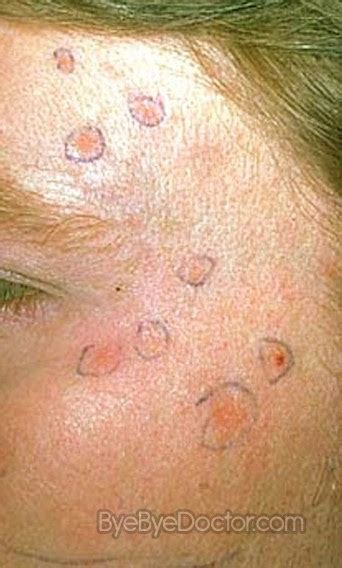 Actinic Keratosis Picture Causes Treatment Images Minhhai2d Help