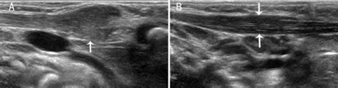 A A Vertical Section Of The Sternocleidomastoid Muscle Scm In A Download Scientific Diagram