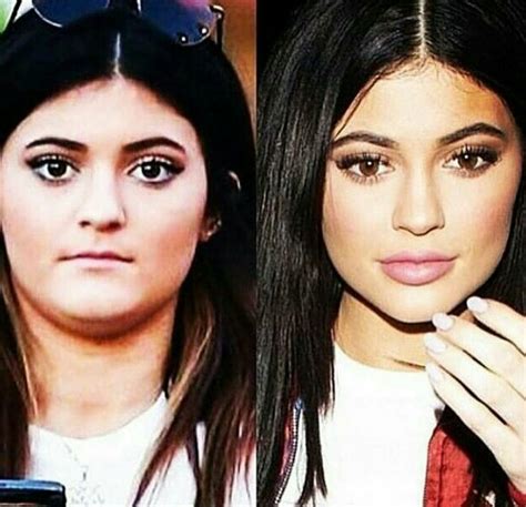 Kylie Jenner Plastic Surgery Before And After Who Magazine
