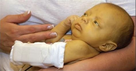What Is Jaundice In Premature Babies Get More Anythinks