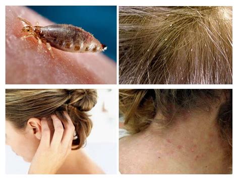 What And How To Remove Head Lice In A Child