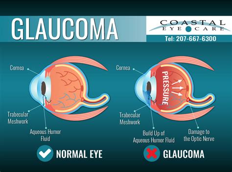 glaucoma treatment glaucoma treatment attleboro glaucoma surgery pawtucket dr fay treatments