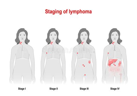 Staging Of Lymphoma Woman Silhouette With Highlighted Internal Stock