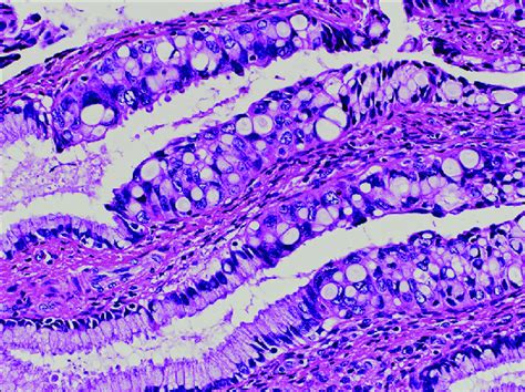 Histological Picture Of Endocervical Polymorphic Adenocarcinoma In