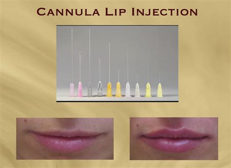 Lip Cannula Injection Is The Best Technique For Lip Fillers Dr