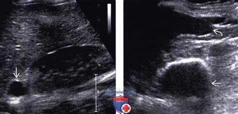 Методы обследования кисты надпочечника Картинка - Методы обследования кисты надпочечника