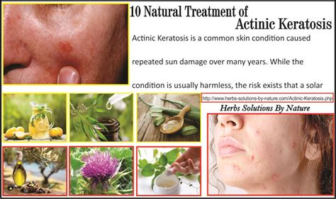 10 Actinic Keratosis Natural Cure And Home Remedies