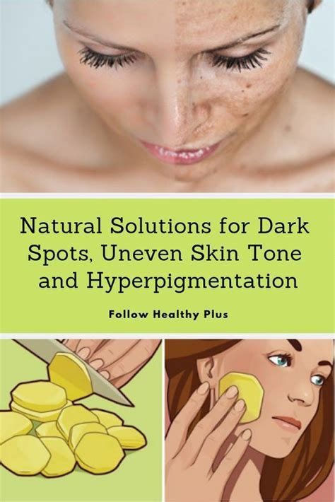 Natural Solutions For Dark Spots Uneven Skin Tone And