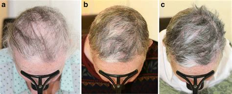 Put on a dry scalp. Successful treatment of acute diffuse and total alopecia ...