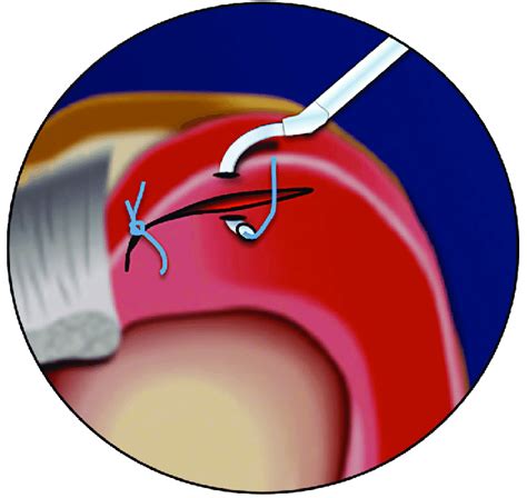 Suture Repair Of A Posterior Medial Meniscus Tear With A Hook Download Scientific Diagram