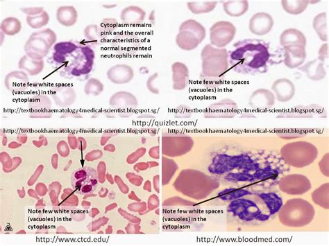 Haematology In A Nutshell Vacuolated Neutrophils