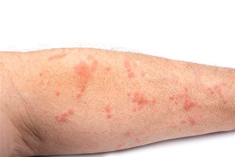 Skin Disease Rash On A Man Arm Stock Photo Download Image Now Mite