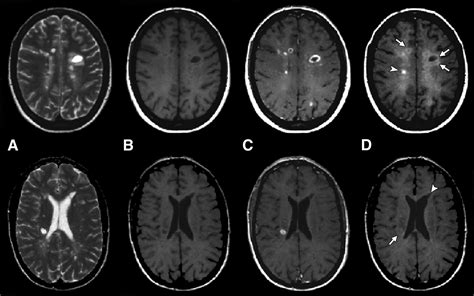 Mr Imaging Of Multiple Sclerosis Radiology